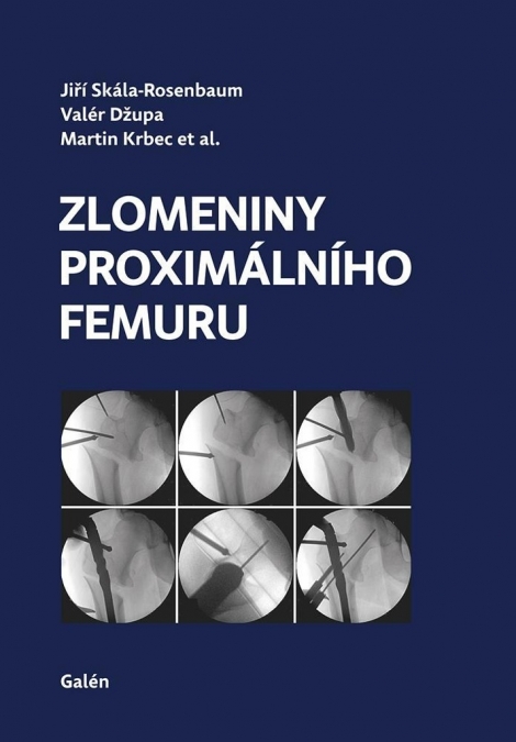 Zlomeniny proximálního femuru - 