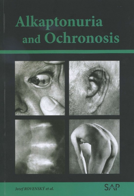 Alkaptonuria and ochronosi - 