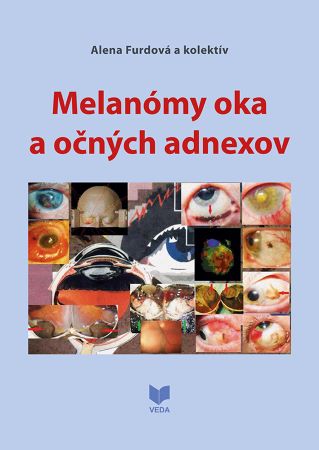 Melanómy oka a očných adnexov - 