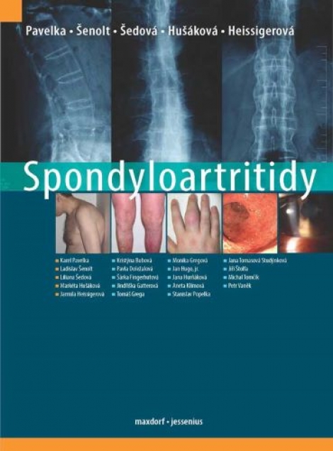 Spondyloartritidy - 