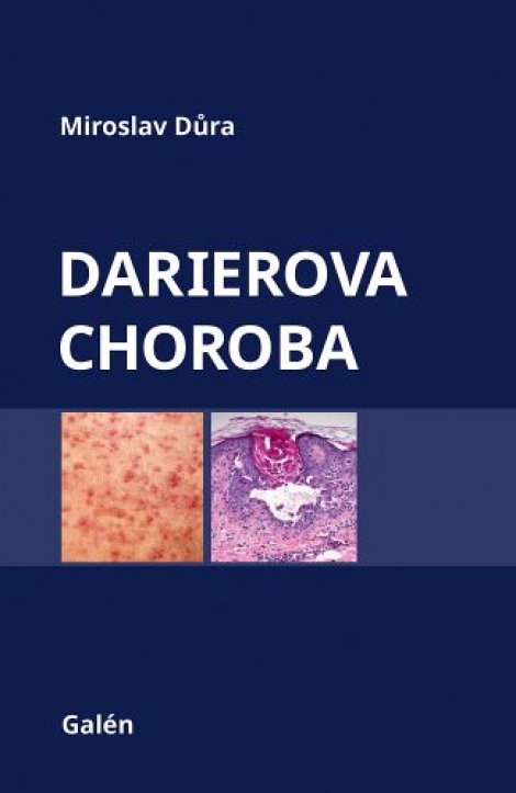 Darierova choroba - 