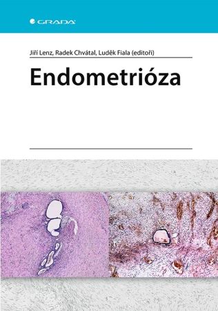 Endometrióza - 