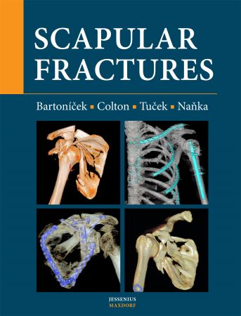 Scapular fractures - 