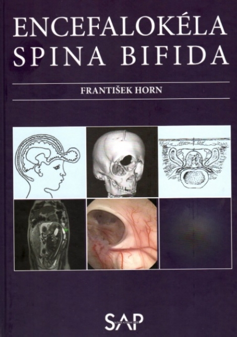 Encefalokéla spina bifida - 