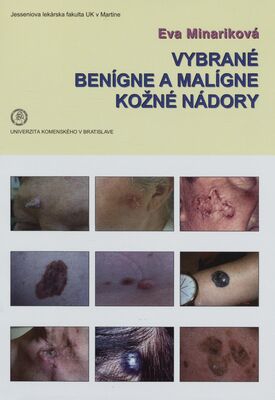 Vybrané benígne a malígne kožné nádory - 
