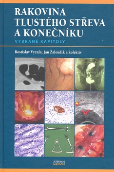 Rakovina tlustého střeva a konečníku - 
